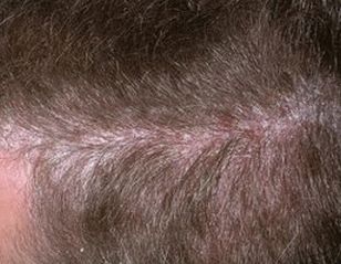 luskavica bolezen lasišča in lasišča, fotografija začetne stopnje