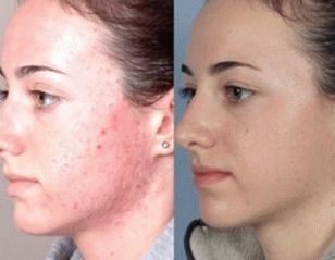 fotografija kože obraza po zdravljenju luskavice